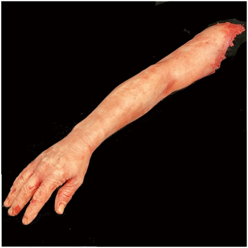 Silicone Severed Full Arm